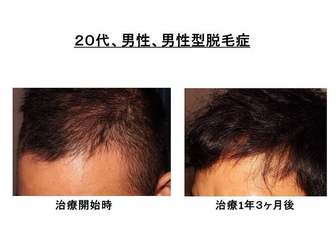 円形脱毛症　病院""